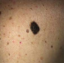 leser trelat dermatosis seborreica